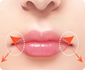 Lip Lift surgery